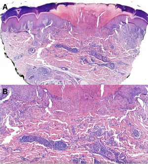 Panoramic microphotography stained with hematoxylin/eosin (H/E, 40×) from a biopsy obtained from a palmar lesion showing a disruption of the epidermis along with localized collagen alteration and an inflammatory infiltrate in the mid and upper dermis. A central keratotic plug was distinctly visible, imparting a cup-shaped contour to the lesion through which collagen was extruded transepidermally. Dermal perforation was evident (A). Histopathologic examination revealed collagen degeneration with necrobiotic features and a perivascular lymphohistiocytic infiltrate. Histiocytes arranged in a palisading pattern surrounded areas of degenerated collagen and mucin deposits (H/E, 200×) (B).
