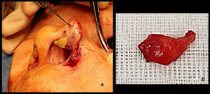 (a) Donor area (shaded in yellow) after perialar approach. (b) Resulting convex chondromucosal graft.