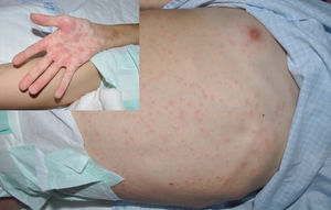 DRESS, drug reaction with eosinophilia and systemic symptoms.