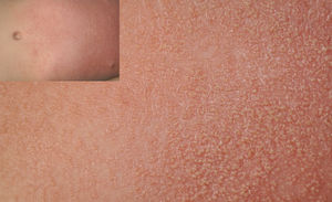 AGEP, acute generalized exanthematous pustulosis.