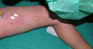 TEN, toxic epidermal necrolysis.