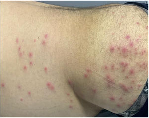 Pseudomonas aeruginosa folliculitis. Multiple monomorphic pustules with an erythematous base, intensely pruritic, located on the trunk and gluteal region, with marked clustering in the swimsuit area.