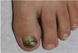 Green nail syndrome. Dark green discoloration involving the entire nail plate.