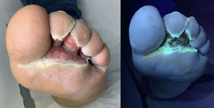 Pseudomonas aeruginosa infection of the feet (intertrigo). (A) Rounded ulcers with macerated (“moth-eaten”) borders, intensely painful, located in the interdigital spaces of all toes on both feet. (B) Wood lamp examination showing intense green fluorescence at the borders.