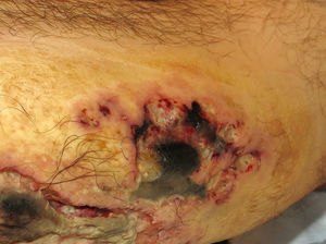Ecthyma gangrenosum. Necrotic ulcers with an erythematous halo on the leg of an immunosuppressed patient.