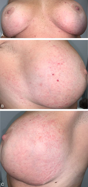 (A–C) Initial clinical presentation: Diffuse erythematous macules located on the inferior and outer lateral regions of both breasts. Clinical images. (D) Superficial perivascular dermatitis with predominant lymphohistiocytic inflammatory infiltrate and lymphatic vascular ectasia with prominent endothelial cells (Hematoxylin–Eosin ×400). (E) Ectatic lymphatic vessels demonstrated by immunohistochemical staining (D2-40 ×200).