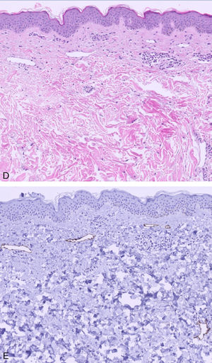 (A–C) Initial clinical presentation: Diffuse erythematous macules located on the inferior and outer lateral regions of both breasts. Clinical images. (D) Superficial perivascular dermatitis with predominant lymphohistiocytic inflammatory infiltrate and lymphatic vascular ectasia with prominent endothelial cells (Hematoxylin–Eosin ×400). (E) Ectatic lymphatic vessels demonstrated by immunohistochemical staining (D2-40 ×200).