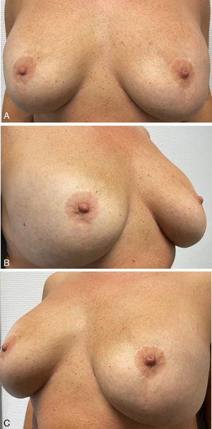 (A–C) Clinical response after treatment. Complete resolution of the lesions is observed.