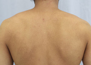 Twelve weeks into upadacitinib, 4 weeks after treatment discontinuation.