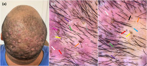 (a) Clinical image of a 55-year-old transgender man on androgen hormone therapy showing nodules, pustules and alopecia on the vertex and mid-scalp. (b) Trichoscopic image demonstrating a three-dimensional yellow dot (yellow arrow), polytrichia (green arrow), a large brown dot (orange arrow), diffuse erythema (white arrow), cutaneous clefts with emerging hairs (pink arrow), peri- and interfollicular scale (purple arrow), and broken hairs (red arrow). (c) Trichoscopy image showing a three-dimensional yellow dot (yellow arrow), polytrichia (green arrow), structureless area (blue arrow), short regrowing hair (orange arrow), diffuse erythema (white arrow), peri and interfollicular scales (purple arrow), black dots (black arrow), and broken hair (red arrow).