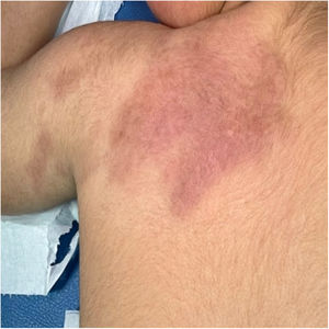 Erythematous, indurated, and infiltrated plaque on the lateral area of the left arm with spread toward the back.