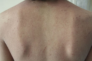Before initiating treatment with upadacitinib.