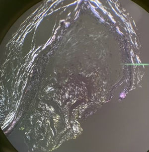 Polarized light examination.
