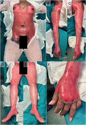 Skin lesions at the time of consultation. Epidermal detachment with generalized involvement: trunk (panel A), both upper limbs (panels B and C), lower limbs (panels D and E). The involvement spared the distal region of the hands (panel F), face and partial neck, and genitalia.