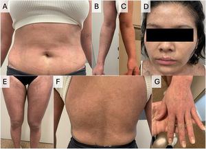 Skin lesions 10 days after discharge. Resolution of the lesions can be appreciated, with generalized post-inflammatory hyperpigmentation and small erosions. The acrofacial region (panels D and G) was intact.