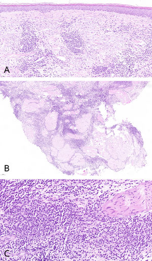 (A–C) Hematoxylin–eosin stain: dermal lymphocytic infiltrate without epidermotropism.