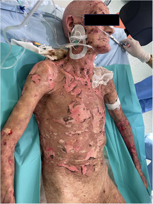 Extensive epidermal detachment involving the trunk, upper and lower extremities, and back (BSA 60%) 26 days after pembrolizumab administration.