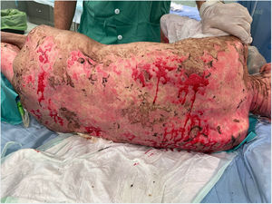 Extensive epidermal detachment involving the trunk, upper and lower extremities, and back (BSA 60%) 26 days after pembrolizumab administration.