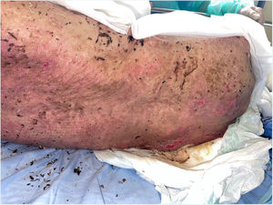 Near-complete re-epithelialization with marked clinical improvement 16 days after initiation of cyclosporine.