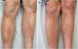 Clinical images. (a) Alopecic, sclerotic-appearing plaques with a violaceous halo on both pretibial regions. (b) Marked improvement of the lesions 7 months after simvastatin discontinuation and 3 months after methotrexate initiation.
