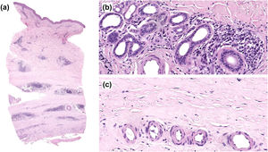 Histopathologic images. (a) Low-power view showing thickened dermis due to collagen deposition extending into the deep portion of the biopsy (H&E, ×1). (b) Detail of a group of eccrine glands with atrophy and absence of surrounding adipose tissue, replaced by collagen, along with numerous plasma cells (H&E, ×20). (c) Vessels with markedly thickened walls and pronounced dermal homogenization (H&E, ×20).