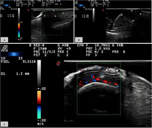 (A) Hypoechoic 5.6mm×1.6mm mass on the proximal nail fold overlying the nail plate without matrix involvement and minimal basal vascularity. (B) Well-defined 5.2mm×2.8mm hypoechoic lesion. (C) Frontal view of a 1.5-mm hyperechoic lesion, unrelated to underlying structures and without Doppler flow.