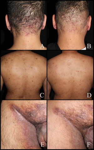 Case #1, clinical improvement after linezolid use. A, C, E. Inflammatory nodules on the neck, retroauricular region, back, and groin before initiating linezolid treatment. B, D, F. Clinical improvement 6 weeks into linezolid therapy.