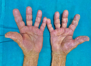 Swelling of both palms and all fingers with pitting on palpation, more pronounced on the 3rd finger.