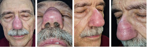 Erythema and soft-tissue enlargement of the nasal dorsum.
