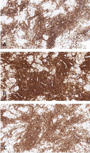 (A) Immunohistochemistry positive for CD20; (B) CD23; (C) BCL-2.