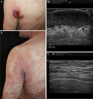 Clinical and ultrasound appearance of case 1 (A–D) and case 2 (E–H). (A) Ulcerated tumoral lesion on the left arm. (B) Ultrasound appearance of the lesion: poorly demarcated heteroechoic lesion occupying the dermis and subcutis, with a thickness of 1.60cm. (C) Clinical appearance of the lesion after 6 months. (D) Ultrasound findings after 6 months showing a thinner lesion, 1.14cm thick. (E) Tumoral lesion on the posterior aspect of the left shoulder. (F) Ultrasound appearance of the lesion: poorly defined heteroechoic lesion occupying the dermis and subcutis, with a thickness of 1.53cm. (G) Clinical appearance of the lesion after 6 months showing a complete response. (H) Ultrasound findings after 6 months showing a complete response.