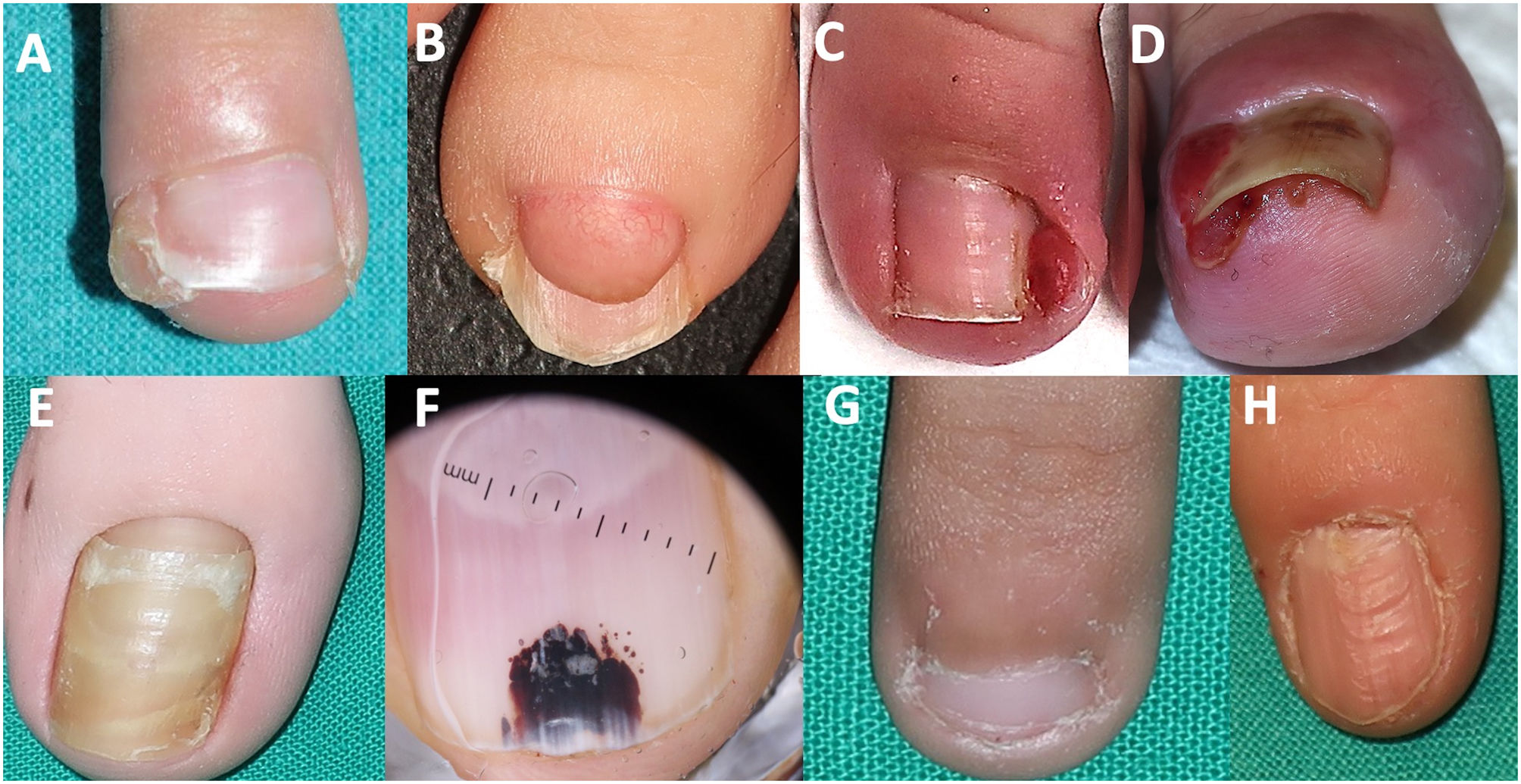 melanotic whitlow pictures Herpetic whitlow, sometimes called finger, is a viral infection caused by the herpes simplex virus. Click the link in the comments to learn more melanotic whitlow finger - Stock
