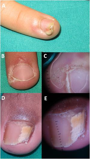 Nail infections. (A) Bacterial paronychia; (B) periungual viral wart; (C) dermoscopic image of the previous patient showing hyperkeratosis and globules corresponding to thrombosed vessels; (D) onychomycosis; (E) dermoscopic image of the previous patient showing multiple colors of the nail plate (“aurora borealis”); (F) frontal image of the same patient with onychomycosis showing subungual hyperkeratosis and a “ruined nail” appearance.