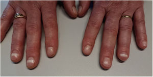 Transverse white lines on fingernails lines affecting the entire width of the nail plate.