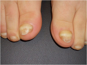 Transverse white lines affecting the toenails.