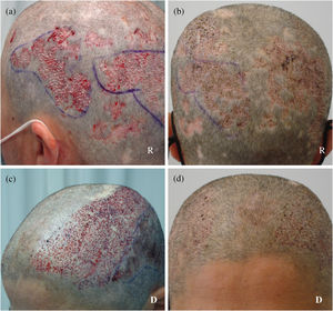 (a and b) Extraction from the lower frontal and parietal regions so that hair descending from the upper region with styling could compensate for potential resulting hair deficiency. (c and d) Due to the limited donor area, implantation prioritized the large scars of the upper and middle regions so that the hair would cover the remaining small lower scars. R: recipient area; D: donor area.