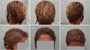 (a–c) The result at 1 year demonstrated complete coverage, allowing the patient to cover all areas even with short hair. (d–f) In the donor area, the patient surprisingly decided to wear a side part coinciding with the extraction area, as she reported not perceiving a decrease in density. R: recipient area; D: donor area.