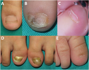 Congenital nail disorders. (A) Isolated brachyonychia; (B) double nail; (C) vertically implanted nail; (D) congenital malalignment of the first toenail of both feet and pincer nail; (E) micronychia.