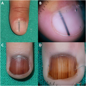 Congenital nail matrix nevi (melanonychia). (A) Longitudinal melanonychia in a child; (B) dermoscopic image showing a homogeneous pattern; (C) melanonychia covering the entire nail plate in an infant; (D) dermoscopy showing irregular longitudinal lines, globules, periungual pigmentation, and the distal “brush” sign at the hyponychium.