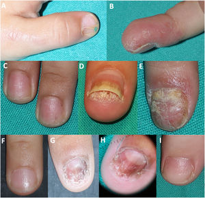Inflammatory nail disease. (A) Lichen striatus in a child with flat skin-colored papules arranged linearly on the dorsum of the first finger, associated with nail plate onychorrhexis; (B) pustules and hyperkeratosis in a patient with pustular parakeratosis affecting a finger; (C) nail pitting in a patient with psoriasis; (D) oil-drop sign, distal onycholysis, and subungual hyperkeratosis in a patient with psoriasis; (E) onychodystrophy and splinter hemorrhages in a patient with nail psoriasis; (F) superficial pitting in a patient with alopecia areata; (G) melanonychia, nail dystrophy, and erythema of the nail bed in a child with nail lichen planus; (H) dermoscopy showing nail bed and lunular erythema, splinter hemorrhages, and melanonychia in the previous patient; (I) trachyonychia.