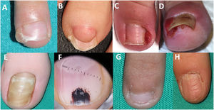 (A) Subungual exostosis; (B) periungual fibroma in a patient with tuberous sclerosis; (C) pyogenic granuloma secondary to onychocryptosis in an adolescent; (D) frontal view of a pyogenic granuloma in a patient with onychocryptosis; (E) retronychia; (F) dermoscopic image of a subungual hematoma; (G) nail with reduced longitudinal diameter in a patient with onychophagia; (H) “Washboard nail” appearance in a patient with onychotillomania.