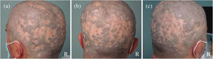 (a–c) Large plaques of cicatricial alopecia without inflammatory signs affecting the vertex and the entire temporal and occipital regions, preventing coverage of the scalp with the limited remaining hair. R: recipient area.