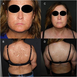 (A–D) Generalized hyperpigmentation with ephelides, lentigines, and atypical nevi prior to the initiation of nivolumab (A and B), and subsequent facial (C) and truncal (D) lightening with resolution of lesions 7 months after treatment discontinuation. Irregular whitish macules are present on the trunk due to surgical procedures.