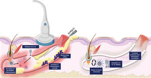 Role of the inflammasome in the pathophysiology of inflammatory tunnels in hidradenitis suppurativa and mechanism of action of percutaneous galvanic current. Following inflammasome activation and the bactericidal effect of the current, tunnel fibrosis and elimination of biofilms are achieved.