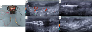 Galvani-K® device and ultrasound-guided procedure. (A) Galvanic current generator with integrated Abbocath catheter adapter and contact electrode. (B) HS inflammatory tunnel before treatment initiation with inflammatory hyperemia identified by Doppler. (C) Abbocath catheter inserted inside the tunnel under ultrasound guidance. (D) Hyperechogenic sclerosis line after administration of galvanic current and withdrawal of the Abbocath catheter. (E) Week 12 into therapy: disappearance of inflammatory hyperemia on Doppler signal, reduction in longitudinal diameter, and decrease in perilesional edema.