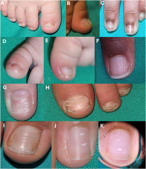 Physiological nail findings. (A) Fragile nail in an infant; (B) koilonychia in an infant; (C) periungual hyperpigmentation; (D) congenital hypertrophy of the nail folds; (E) erythema and edema of the lateral nail fold in an infant with congenital hypertrophy of the nail folds; (F) Chevron or “fishbone” nails; (G) Beau