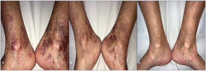 One of the patients with GET treated with PDL (595nm). (a) Before PDL, multiple telangiectasias on the distal legs, ankles, and dorsum of the feet. (b) After 1 session of PDL, partial improvement of the lesions. (c) After 2 sessions of PDL, almost complete clearance of the lesions.