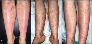 Another patient with GET treated with PDL (595nm). (a) Before PDL, multiple telangiectasias on the legs. (b) After 4 sessions of PDL, partial improvement of the lesions with postinflammatory pigmentation. (c) After 6 sessions of PDL, slight additional improvement with resolution of the postinflammatory pigmentation.