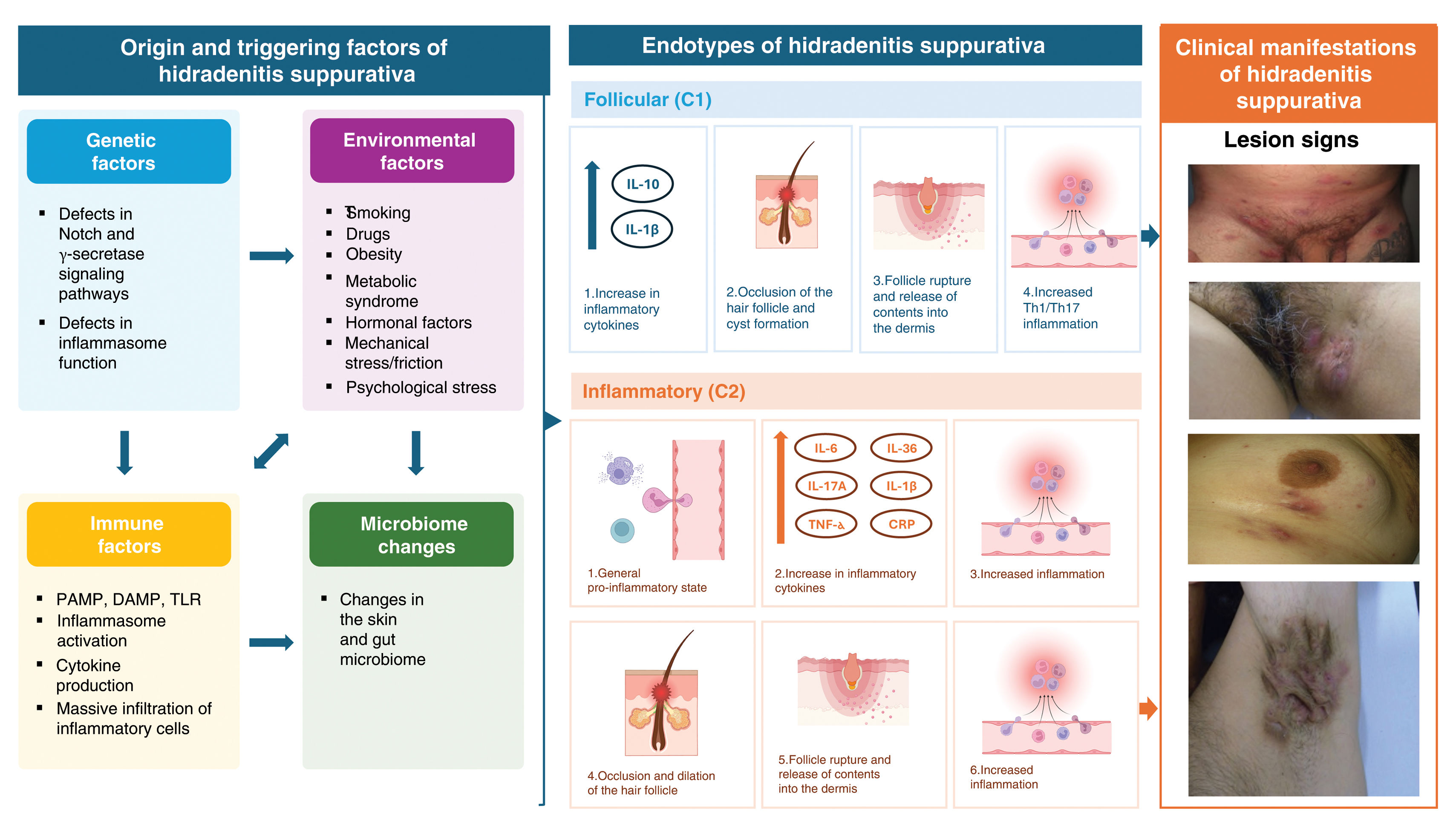 Spanish Clinical Management Guideline for Hidradenitis Suppurativa ...