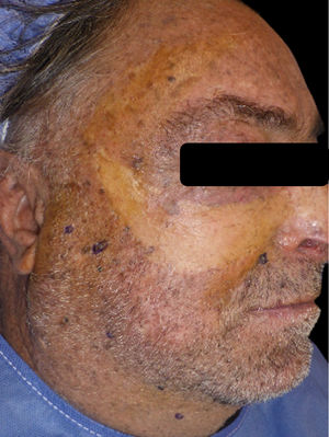 Multiple lesions compatible with basal cell carcinoma before initiation of treatment with sonidegib in the facial region.